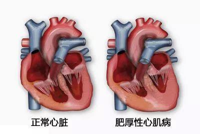 年輕人猝死多因這種心臟??！醫(yī)生提醒：一人發(fā)病全家篩查