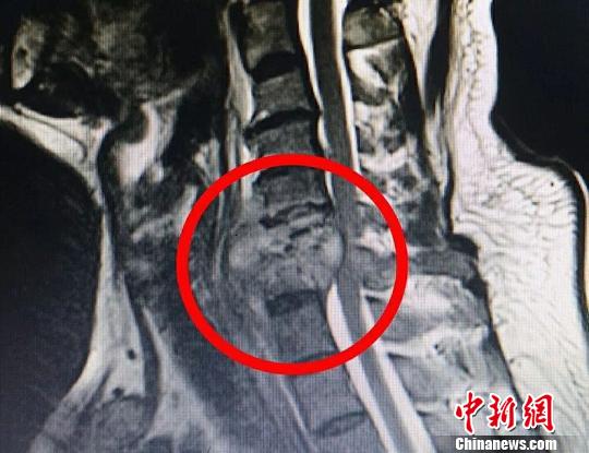 常州醫(yī)生利用MR技術(shù)做手術(shù) 宛如科幻大片 常州醫(yī)生利用MR技術(shù)做手術(shù) 宛如科幻大片