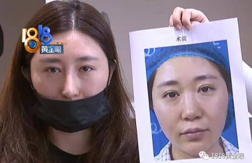 杭州華山連天美整形醫(yī)院把我鼻子做歪了 整的像阿凡達(dá)