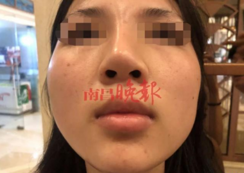 南昌禾麗整形醫(yī)院把我鼻子整歪了 記者介入?yún)f(xié)調(diào)才同意免費(fèi)修復(fù)