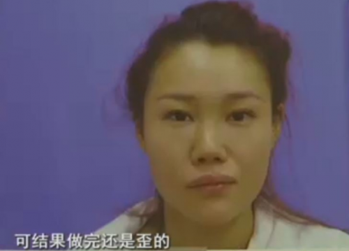 杭州格萊美整形醫院把美女鼻子成了S型 只敢開美顏拍照