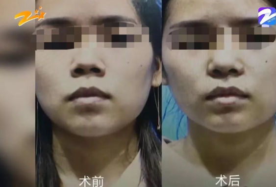 杭州甄美整形醫院把人鼻子整歪了？醫院：自己長歪了