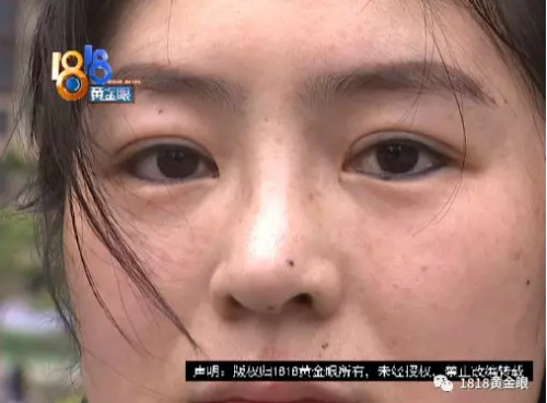 寧波童顏美容整形醫院整形失敗了？女子：被毀容了
