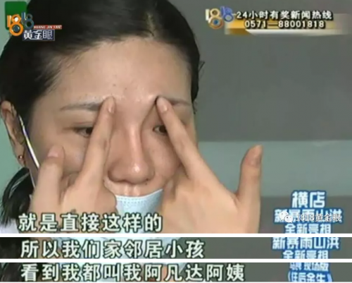 女子在紹興華美整形醫(yī)院整形后眼睛有異物感 鼻子也被整成像阿凡達(dá)