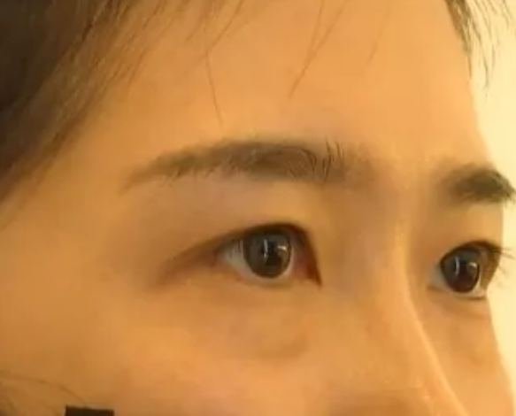 女子在杭州珈禾整形美容醫院打熊貓針結果變成熊貓眼？