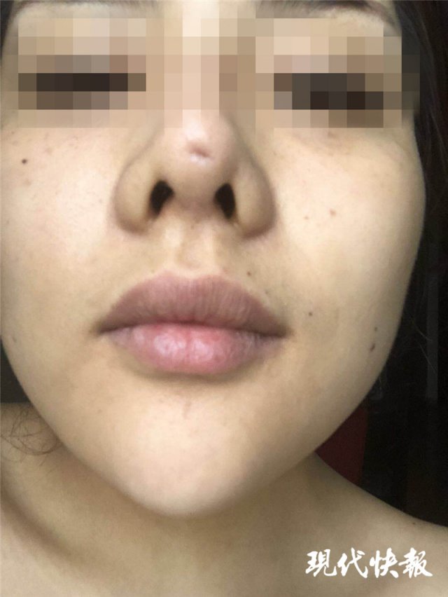 南京怡華醫療美容醫院整形失敗 90后姑娘隆鼻后成了“豬鼻子”
