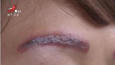 去南昌韓美美容醫院激光洗眉后生不如死 洗完感覺自己像怪物-易網健康<a href=http://www.fnaogov.cn/jkys/ target=_blank class=infotextkey>養生</a>網 去南昌韓美美容醫院激光洗眉后生不如死 洗完感覺自己像怪物