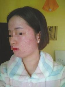 成都蕾特恩專業祛痘怎么樣？推銷陷阱多 81名消費者集體控訴蕾特恩