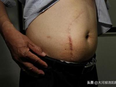 13年前只在洛陽市商業(yè)職工醫(yī)院做過一次闌尾手術(shù) 為何膽囊不見了？