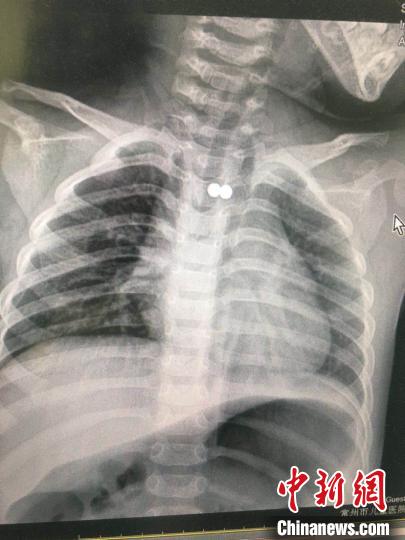 男童誤食兩顆磁力珠 專家通力配合將磁力珠取出-易網<a href=http://www.fnaogov.cn/ target=_blank class=infotextkey>健康養生</a>網 男童誤食兩顆磁力珠 專家通力配合將磁力珠取出