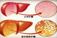 從脂肪肝到肝癌只需4步！做錯這6件事，最容易得脂肪肝！