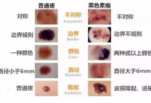 身上的痣千萬(wàn)不要亂摳！痣的5個(gè)惡變信號(hào)，你有嗎？