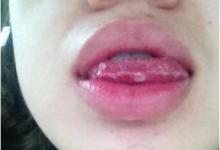 口腔潰瘍痛到發(fā)瘋，3個(gè)小妙招可快速治愈