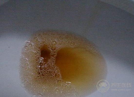 尿液發黃像濃茶？小心是肝膽出了問題！
