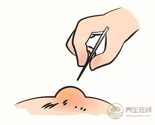 燙傷了怎么辦？6個(gè)處理誤區(qū)，還有很多人用
