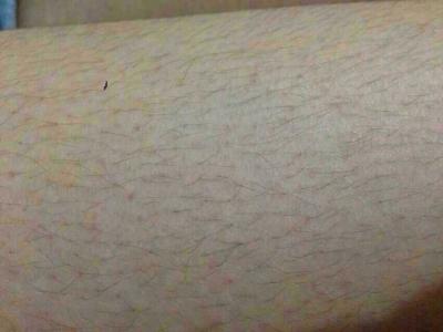 去腿毛的效果能夠達(dá)到永久去除嗎