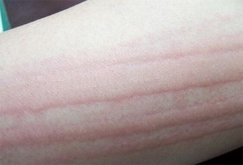 劃痕性蕁麻疹身體需要補充哪些營養(yǎng)