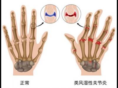 類風濕關節(jié)炎高發(fā)人群存在著哪些特性