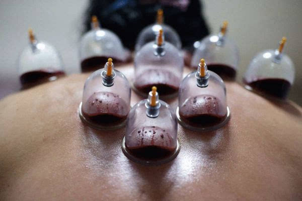 為什么拔罐之后會出現(xiàn)黑色水泡和血泡