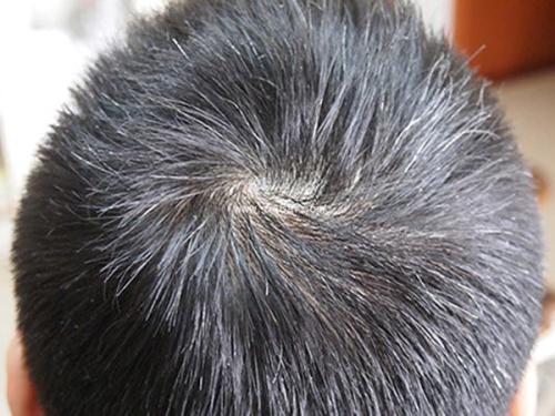 為什么會有人未老頭發(fā)先白的情況發(fā)生