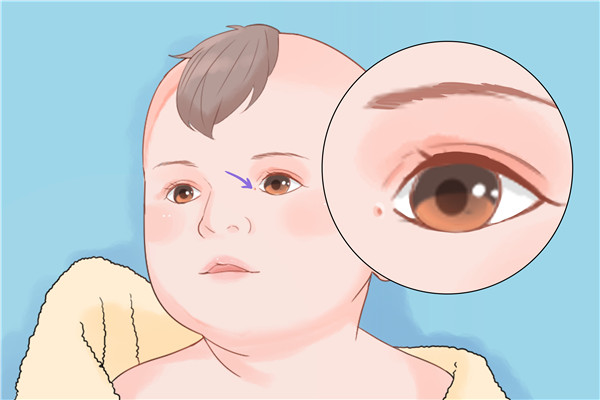 先天性馬蹄內(nèi)翻足表現(xiàn)