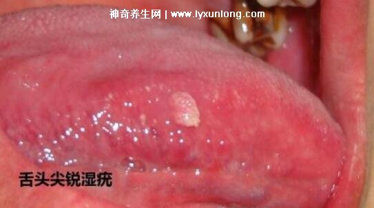 男性早期圖片尖濕銳疣長在哪，生zhi器甚至是口腔(菜花狀疣體出血)