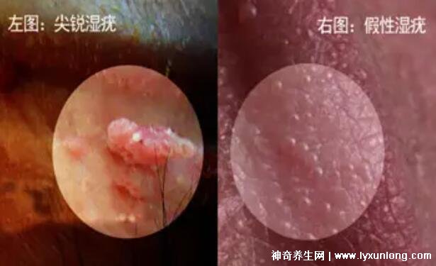 女性假疣和真疣的圖片對比，前者淡紅色和淡褐色魚子狀(5大區別)