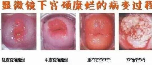 宮頸糜爛一二三度圖片，真實(shí)對比照片(小心是宮頸癌前兆)