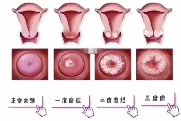 宮頸糜爛一二三度圖片，真實(shí)對比照片(小心是宮頸癌前兆)
