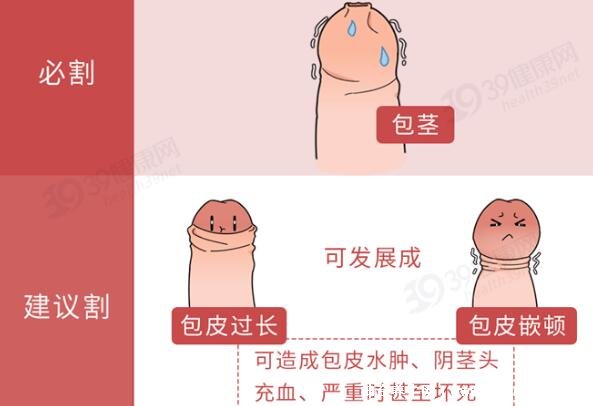 成年男子割包好處和壞處，8種情況必須割(附割包照片真實)
