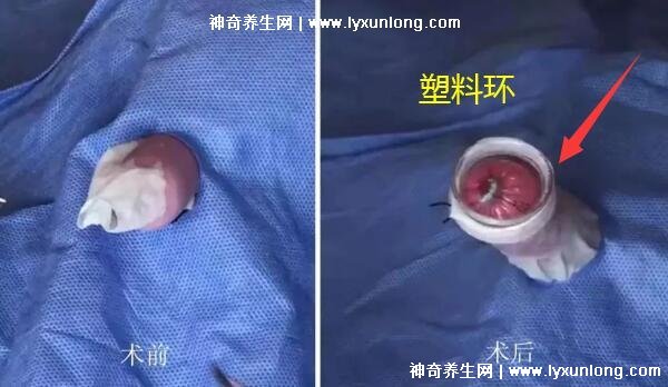 成年男子割包好處和壞處，8種情況必須割(附割包照片真實)