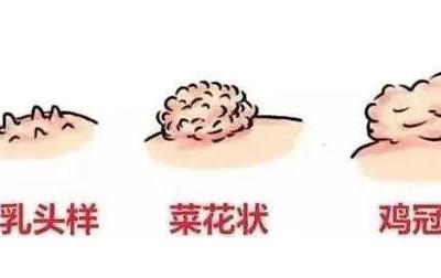 初期尖銳濕尤圖癥狀圖片男性，淡紅色小疙瘩變大為菜花狀疣體