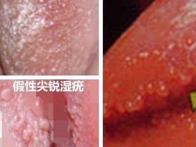 女性假疣和真疣的圖片對比，前者淡紅色和淡褐色魚子狀(5大區別)