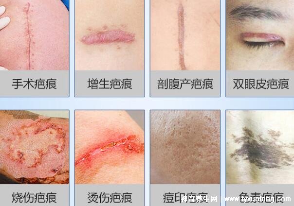 去疤痕最好的十大藥膏，疤克上榜強(qiáng)推康瑞保(3年內(nèi)的疤都能祛)