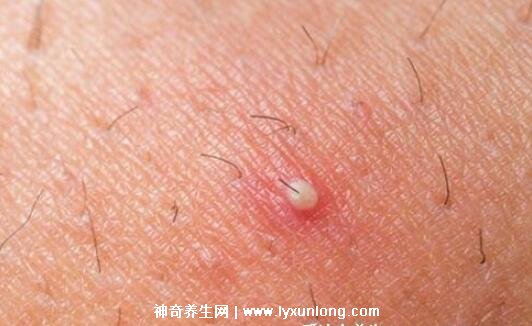 閉口粉刺真正的圖片，粗糙的顆粒會發炎長膿皰(黑頭也是粉刺)