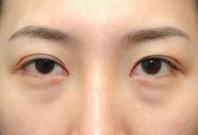  為什么會出現眼袋？怎樣有效去眼袋？