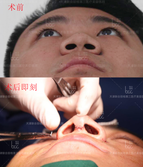 關(guān)于『 萌芽仿生綜合隆鼻術(shù)』你想知道的都在這里！