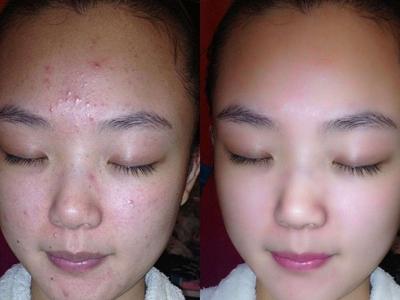 女性長膿包型痤瘡怎么治理，紅腫膿皰護理不當容易留痘疤