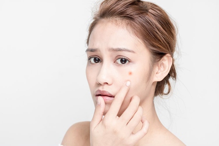 面部痤瘡如何治療，女性針對不同膚質進行治療最佳方法
