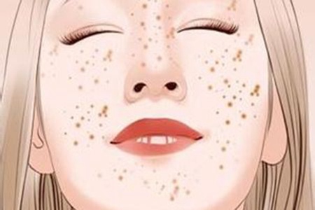 女性激光祛斑會反彈嗎，醫美后五個注意事項