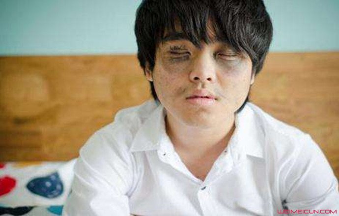 黑眼圈越來越嚴重怎么辦 護膚品效果甚微不如試試這些