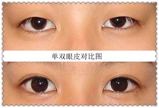 雙眼皮貼久了有害嗎？一天貼多久最適宜？