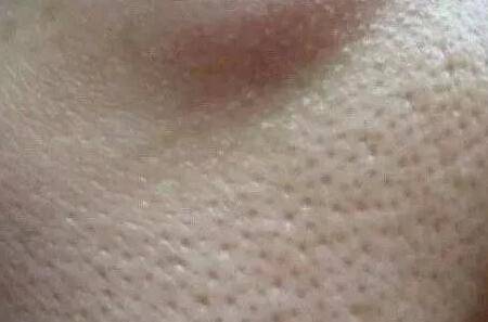 毛孔粗大怎么辦 針對不同情況的毛孔粗大該如何護膚?-易網健康<a href=http://www.fnaogov.cn/jkys/ target=_blank class=infotextkey>養生</a>網 毛孔粗大怎么辦 針對不同情況的毛孔粗大該如何護膚?