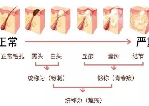 臉上長痘痘怎么調理？做好這三點讓痘痘遠離你