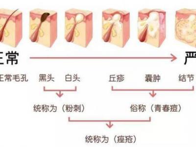 臉上長痘痘怎么調(diào)理？做好這三點讓痘痘遠離你