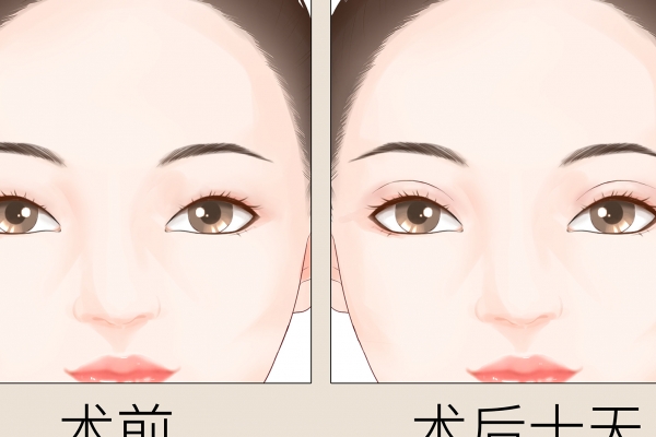 割雙眼皮好不好