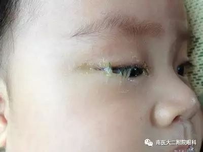 淚道阻塞的癥狀和危害有哪些？