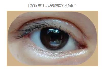 雙眼皮術后出現上瞼下垂怎么辦？