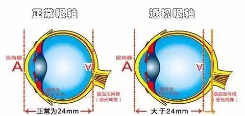 弱視是怎么形成的？它與近視有哪些區(qū)別？