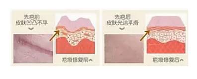 雙眼皮術后出現上瞼下垂怎么辦？